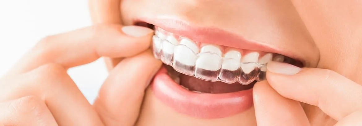 ClearCorrect Aligners